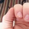 Углубление на ногтях рук: внешний вид ногтей Вмятины на ногтевой пластине